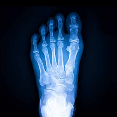Foot X-ray